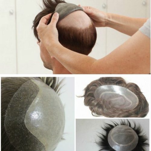 Hair Replacement in lajpat nagar Ghaziabad